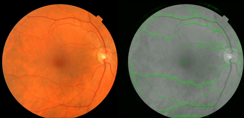 观察你的眼睛就能预测出心脏病？谷歌的新人工智能算法可以办到