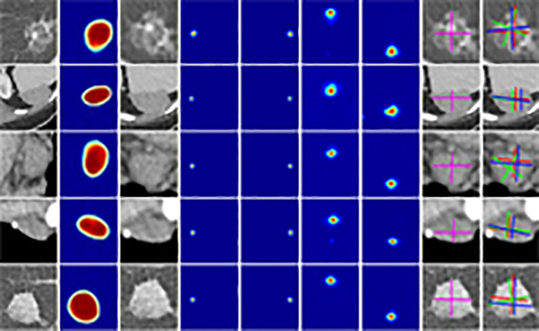 研究团队开发AI使用深度学习方法测量肿瘤